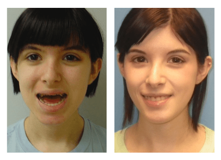 before and after photos of girl with jaw surgery