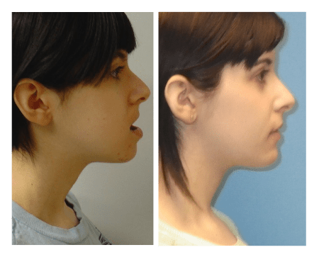 side view before and afters of girl with jaw surger