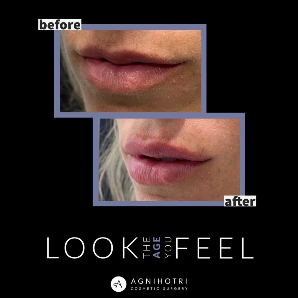 Lip filler before and after photos