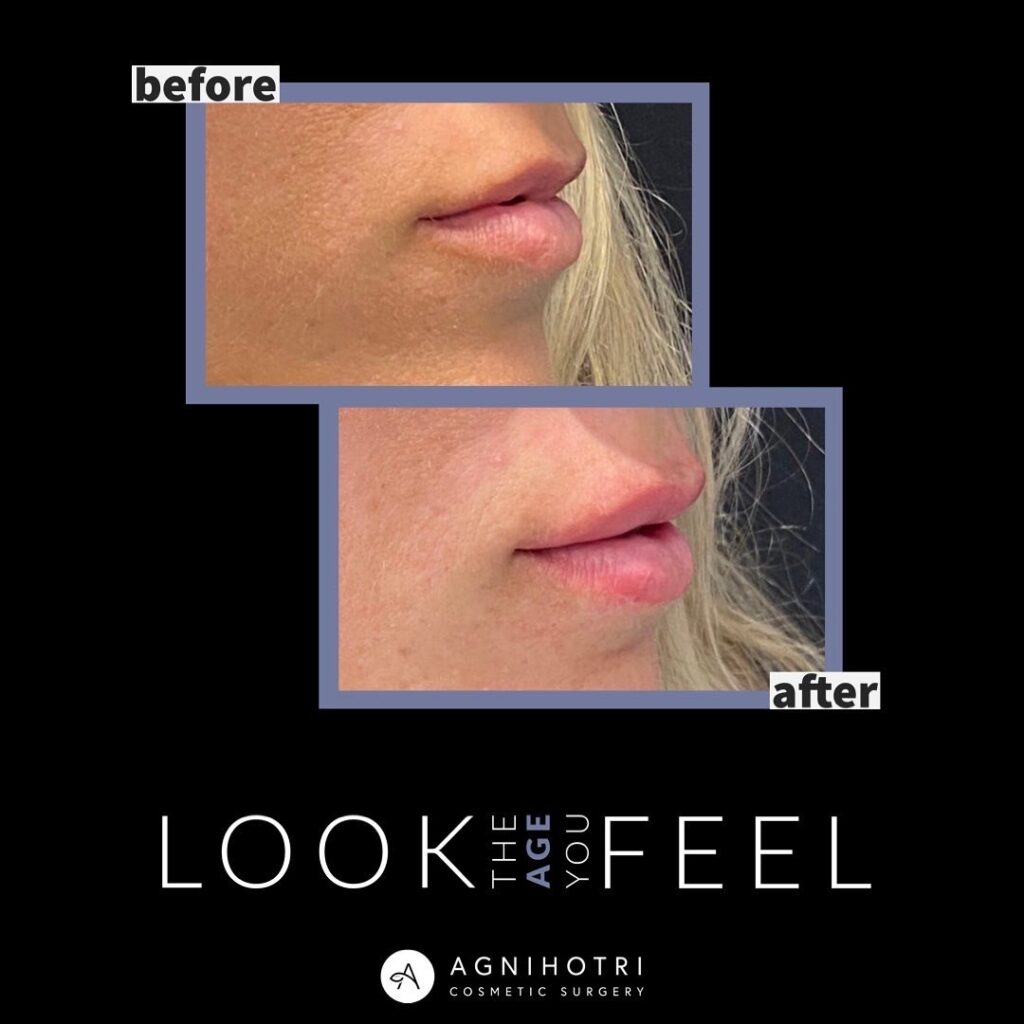 Lip filler before and after photos